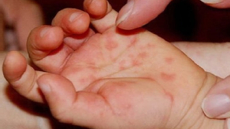 Virus EV71 tấn công trẻ mắc tay chân miệng, gây biến chứng thần kinh nguy hiểm